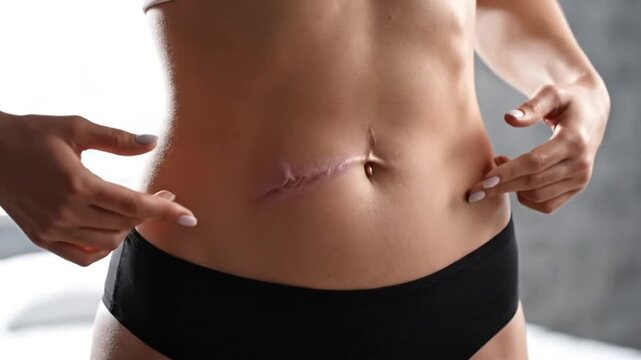 Close Up of Abdomen of Woman with Scar After Surgery in Studio with Natural Lighting Aesthetic and Focus on Healing Process for Medical Publication Use and Body Positivity Concept