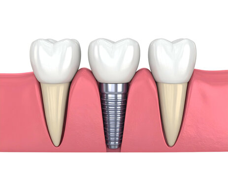Dental implant replacing missing tooth between two natural teeth