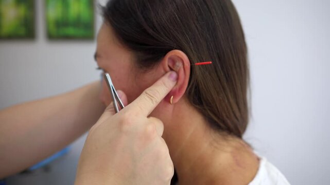 Close up view of an acupuncturist inserting fine needles into a patient's ear during an auricular acupuncture session, a form of traditional chinese medicine for pain relief and wellness