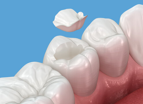 Inlay ceramic crown placement. Medically accurate 3D animation