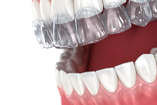Invisalign braces or invisible retainer. Medically accurate dental 3D illustration