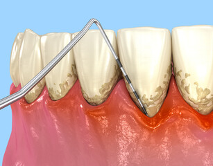 Gum recession test. Dental3D illustration