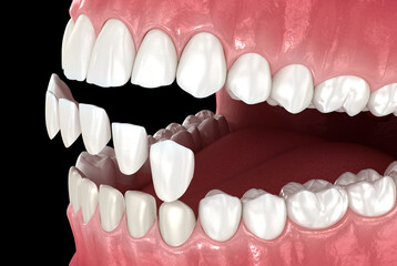 Dental veneer placement over frontal teeth. 3D illustration