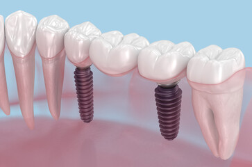 Dental bridge based on two implants. Medically accurate 3D illustration of human teeth and dentures concept