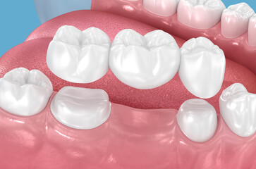 Dental bridge based on 2 teeth. Dental 3D illustration