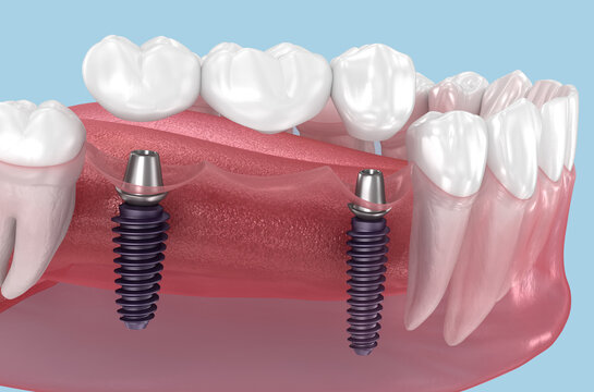 Dental bridge based on two implants. Medically accurate 3D illustration of human teeth and dentures concept