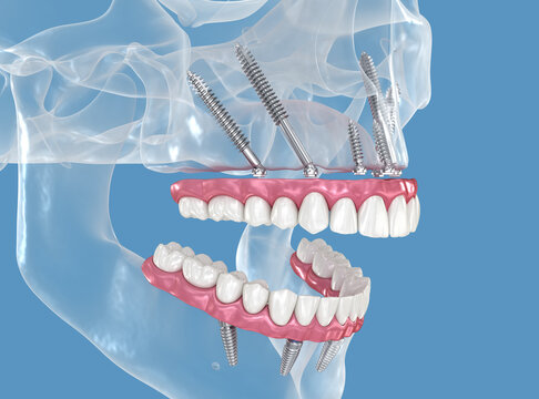 Maxillary prosthesis supported by zygomatic implants. 3D illustration