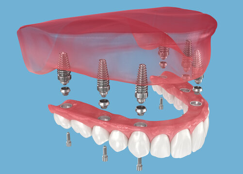 Dental prosthesis based on six implants. 3D illustration