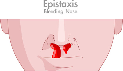 Epistaxis, bleeding from nose nosebleed drops blood flow. Human intelligence, medical draw. Vector illustration