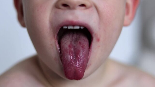 Close up of a red tongue of scarlet fever disease of a small child