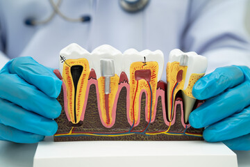 Asian dentist holding dental implant, artificial tooth roots into jaw, root canal of dental...