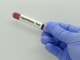 Obraz premium Doctor holds blood sample for Liquid biopsy test to detect cancer cells or DNA fragments.