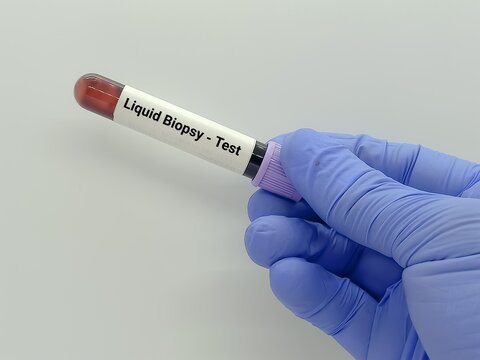 Doctor holds blood sample for Liquid biopsy test to detect cancer cells or DNA fragments.