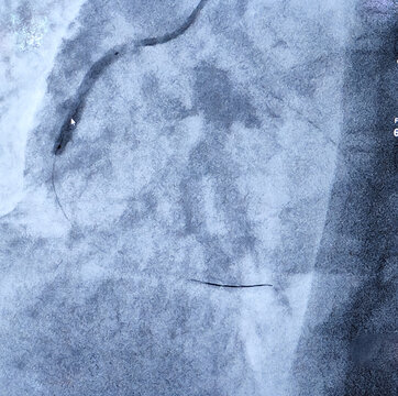 Coronary angiogram with PTCA of right coronary artery during cardiac catheterization with contrast dye. RCA CTO findings and stenting. Colour adjust.