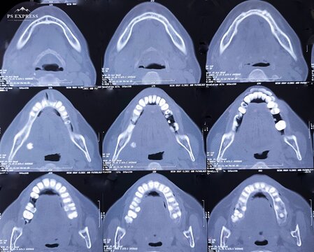 CT scan of Fasial region with maxilla and mandible. Enlarged submandibolar gland with a stone. Most possibly due to submandibular sialadenitis with sialolithiasis.