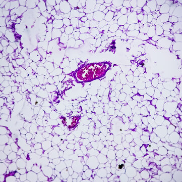 Lipoma, benign growth of fatty tissue, benign neoplasm, adipocytes, partially capsulated tumor, 40x microscopic view.