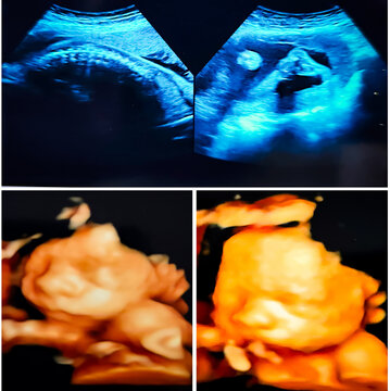 Collage of medical images of ultrasound anomaly scan on a male fetus 25 weeks into the pregnancy, inside womb. Anomaly scan usg.