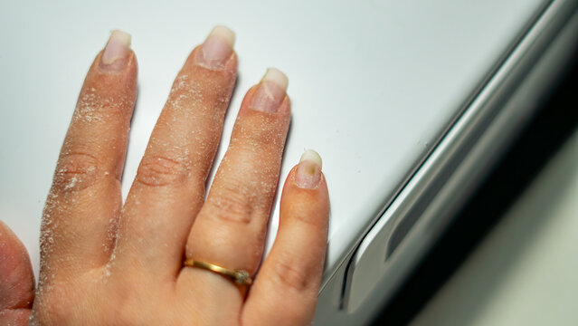 Nail infection caused by blue-green Pseudomonas aeruginosa bacteria on little finger during manicure procedure, visible discoloration on fingernail surface