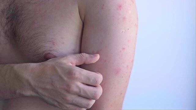 Man with sudden rash large blisters and redness on body typical hives outbreak caused by stress or food allergy