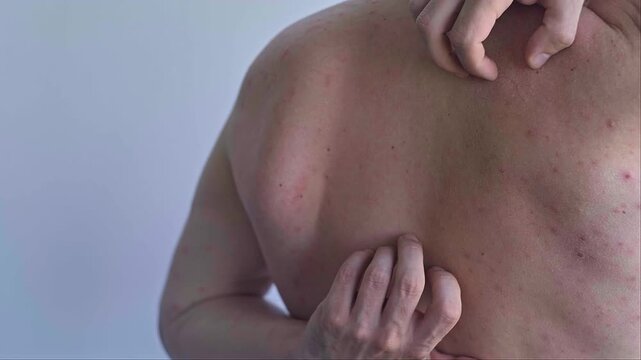 Red rash and blisters cover a man's body showing severe allergic reaction with inflammation and intense itching.
