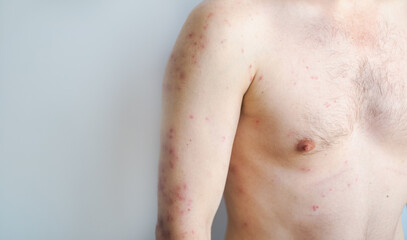 Man with sudden rash large blisters and redness on body typical hives outbreak caused by stress or food allergy