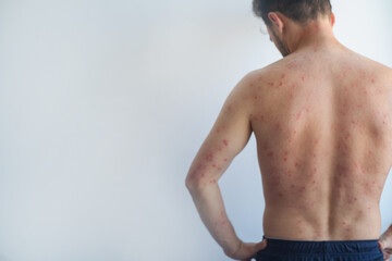Obraz premium Man with inflamed itchy flaky skin on chest back and scalp signs of seborrheic dermatitis