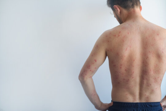 Man with inflamed itchy flaky skin on chest back and scalp signs of seborrheic dermatitis