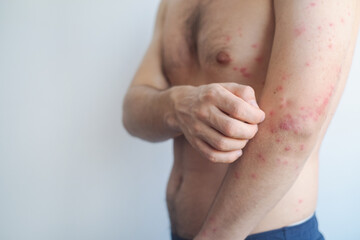 Man covered with small blisters and scabs on chest back and body showing a typical case of adult chickenpox.