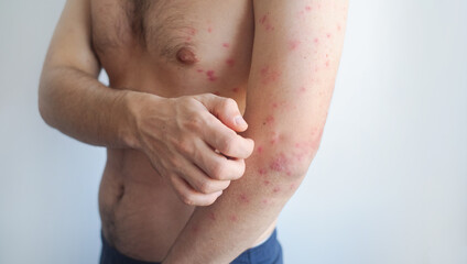 Pink fine rash evenly covers a mans body showing mild viral symptoms with minimal inflammation and...
