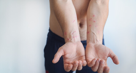 Red scaly itchy patches cover a mans torso and arms showing signs of chronic inflammatory skin disease.