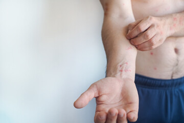 Video shows sudden blisters and redness on a mans body with bright itching typical of widespread...