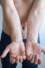 Man experiences severe itching and redness after contact with irritant showing skin inflammation and irritation.