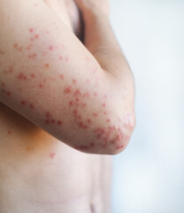 Widespread red itchy patches on a mans skin with dryness and scaling showing flare up of chronic eczema in video.