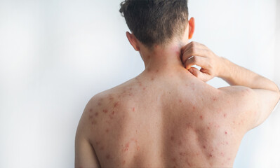 Red inflamed itchy streaks on a mans torso showing viral skin infection affecting nerves in video.