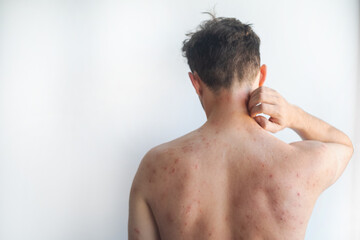 Naklejka premium Red itchy spots and blisters on a mans body from insect bites showing severe skin irritation and inflammation in video.