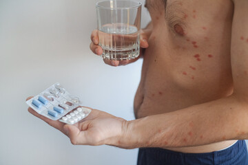 Video shows man with widespread red rash preparing to take medication to treat skin eruptions and reduce inflammation.