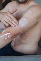 Video shows man applying cream to red irritated skin helping to soothe irritation and reduce itching and discomfort.