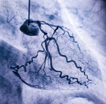 Coronary angiogram of left coronary artery during cardiac catheterization with contrast dye. Abnormal findings. Colour adjust.
