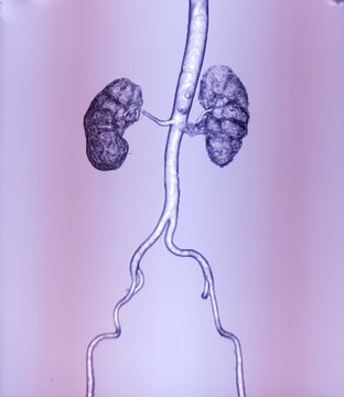 CT scan of KUB with contrast : Left renal small partially exophytic cortical cyst is seen at lower pole. Kidney cyst. Bilateral renal cortical simple cysts.