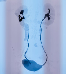 CT scan of KUB with contrast : Left renal small partially exophytic cortical cyst is seen at lower...
