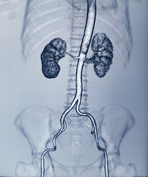 CT scan of KUB with contrast : Left renal small partially exophytic cortical cyst is seen at lower pole. Kidney cyst. Bilateral renal cortical simple cysts.