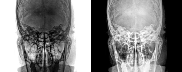 Mastoid Towns View X-Ray Radiograph Showing Mastoid Air Cells for Diagnosis of Mastoiditis,...