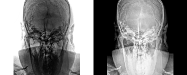 Mastoid Towns View X-Ray Radiograph Showing Mastoid Air Cell Anatomy for Diagnosis of Infections, Fractures, and Fluid Retention Isolated on Transparent Background