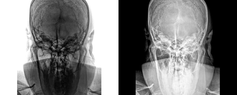 Mastoid Towns View X-Ray Radiograph Showing Mastoid Air Cell Anatomy for Diagnosis of Infections, Fractures, and Fluid Retention Isolated on Transparent Background