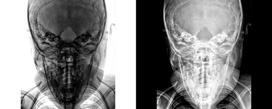 Mastoid Towns View X-Ray Radiograph Displaying Mastoid Air Cell Structure for Diagnosis of Infection and Fluid Collection Isolated on Transparent Background