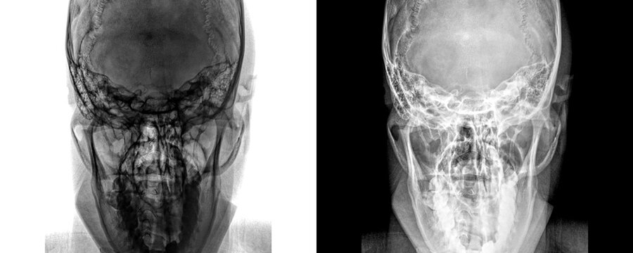 X-Ray of Mastoid Region in Towns View Showing Air Cells and Bony Anatomy for Detection of Mastoiditis and Isolated on Transparent Background