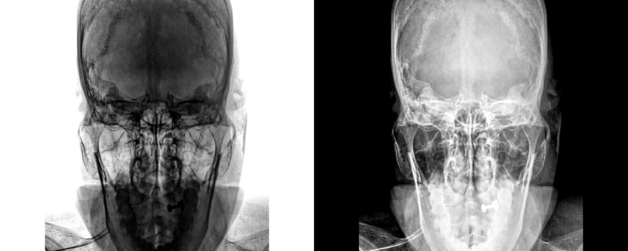 Mastoid Towns View X-Ray Radiograph Showing Clear Visualization of Mastoid Air Cells for Detection of Infections, Fluid Build-Up, and Isolated on Transparent Background.