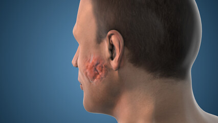 Naklejka premium Human Anatomy Salivary Gland Tumor Growth