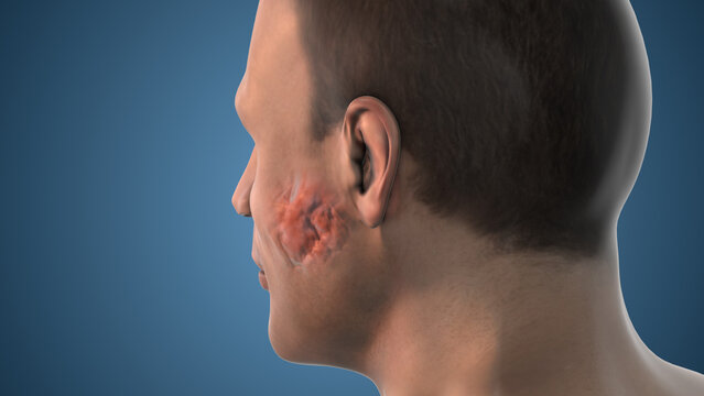 Human Anatomy Salivary Gland Tumor Growth