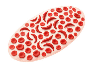 Blood smear displaying sickle-shaped red blood cells indicative of anemia.